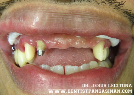 3 missing teeth, central incisors and 1 lateral incisor. - dentistpangasinan.com