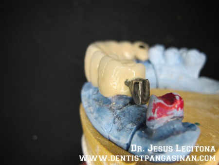 Distal of the fixed-fixed component and the matrix of precision attachment - dentistpangasinan.com