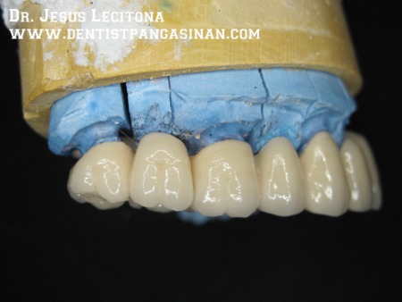 Buccal view of tilite bridge, fixed movable component on the distal of the matrix - dentistpangasinan.com