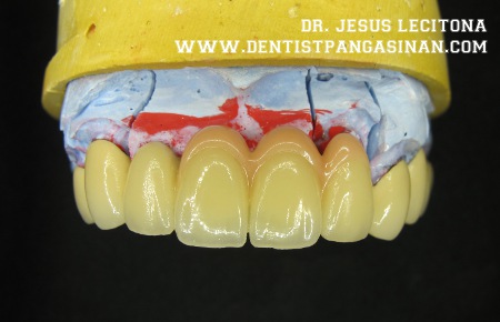 Tilite bridge for a happy patient. - dentistpangasinan.com