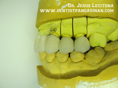 Metal ceramic crowns before glazing. -dentistpangasinan.com