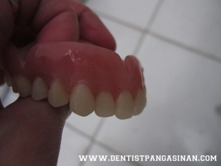 Processed denture