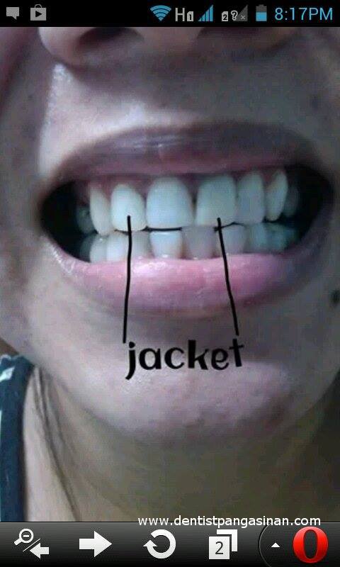 For Braces